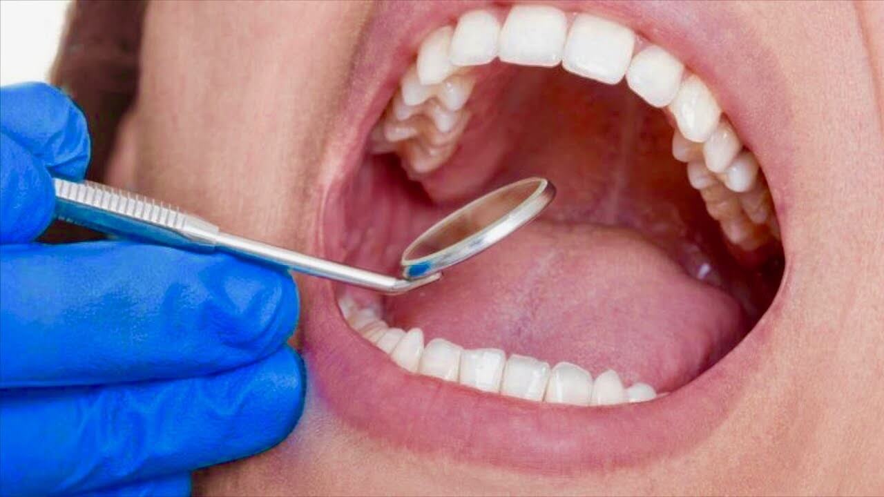 Oral Cancer