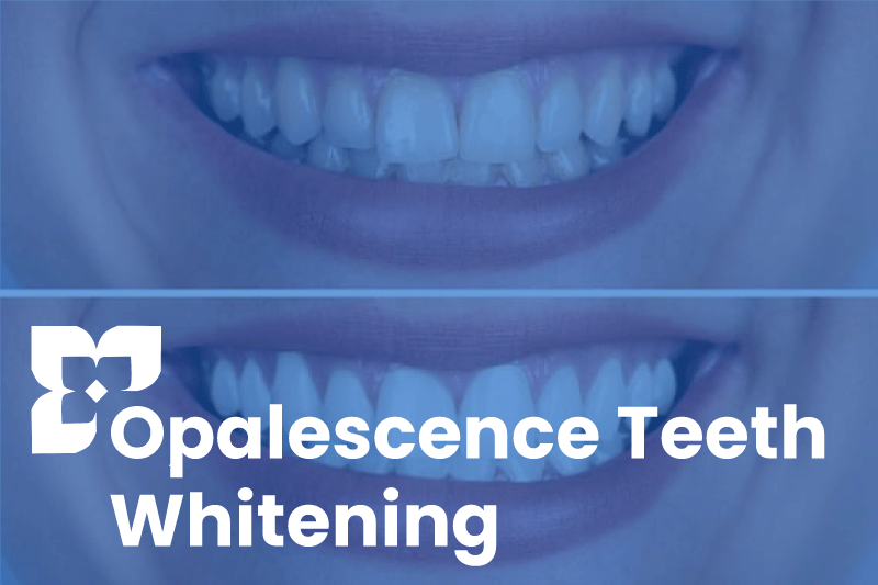 Opalescence Teeth Whitening