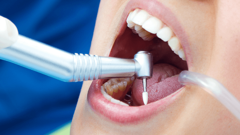 How do I know if I need a root canal?