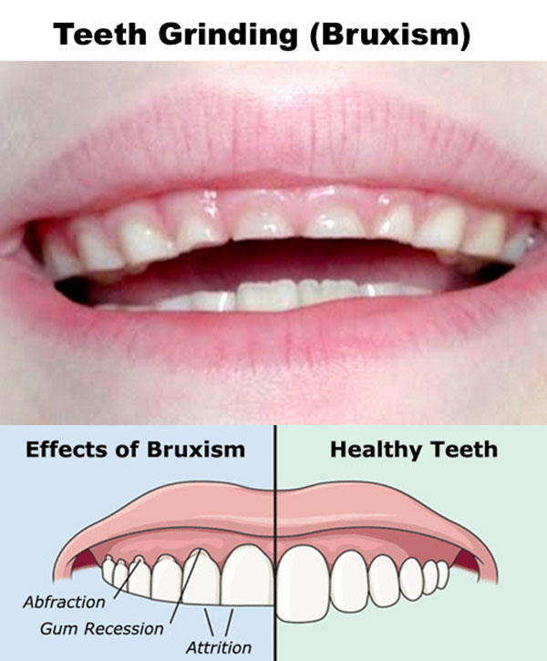 teeth grinding causes