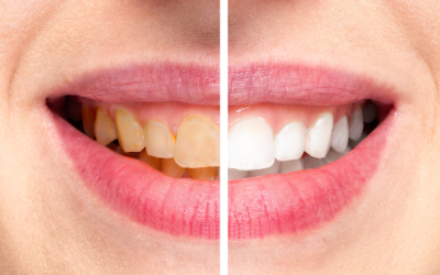 How to Prevent Tooth Discoloration and Keep Your Smile Bright